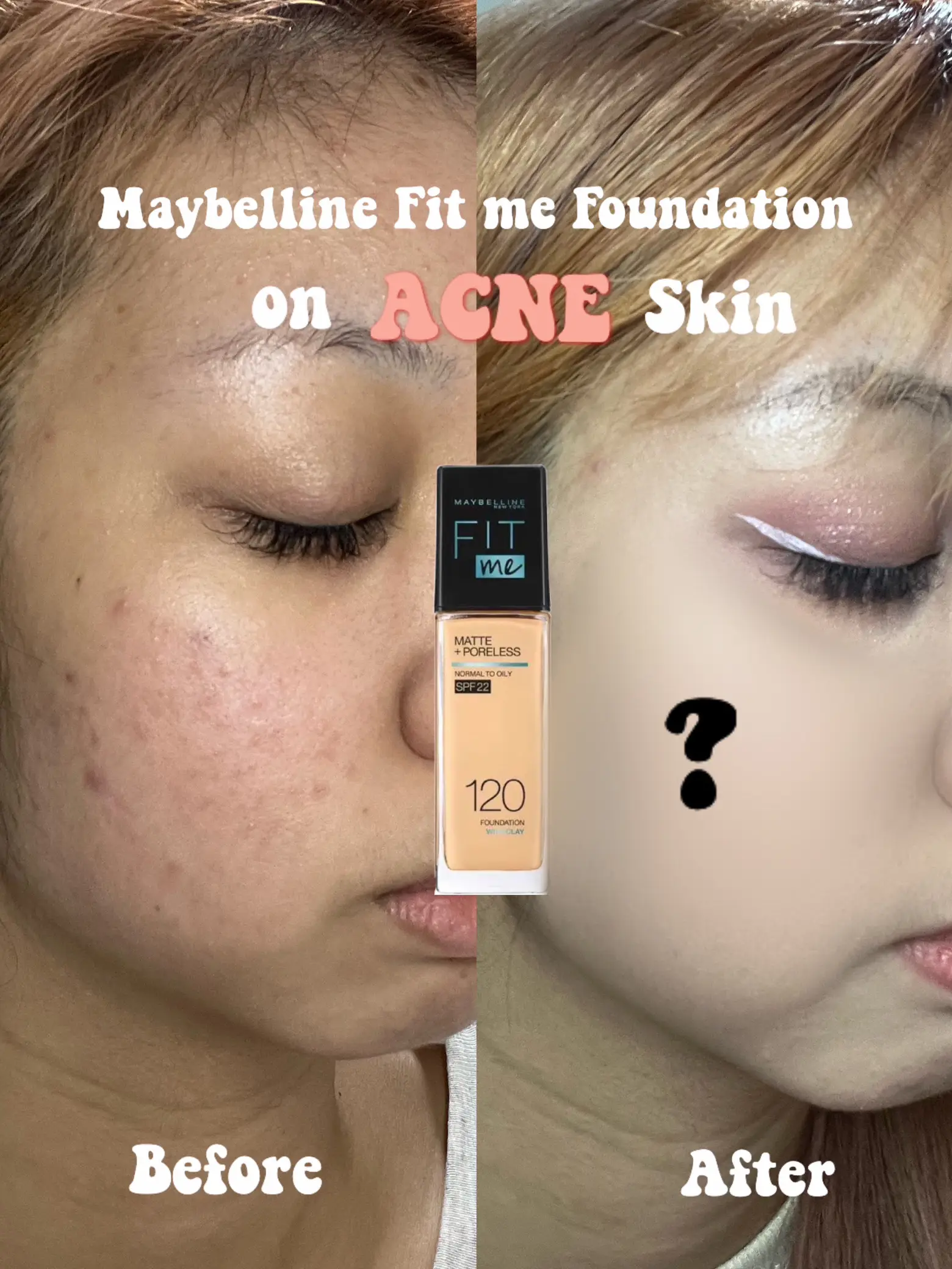 Trying Maybelline Fit me Foundation on acne skin🫣 | Gallery posted by pheezebol🍓 Lemon8